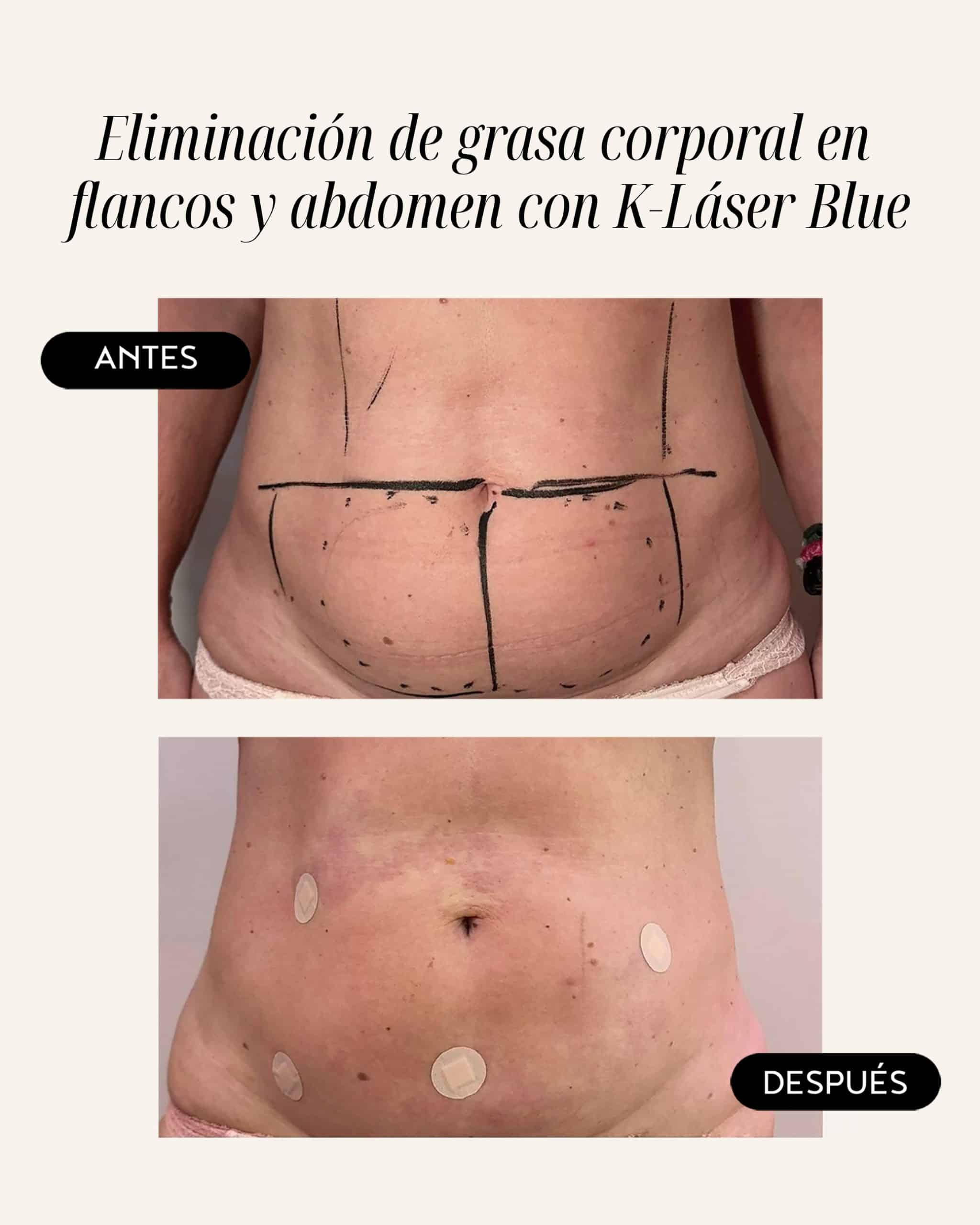 abdomen-y-flancos-01