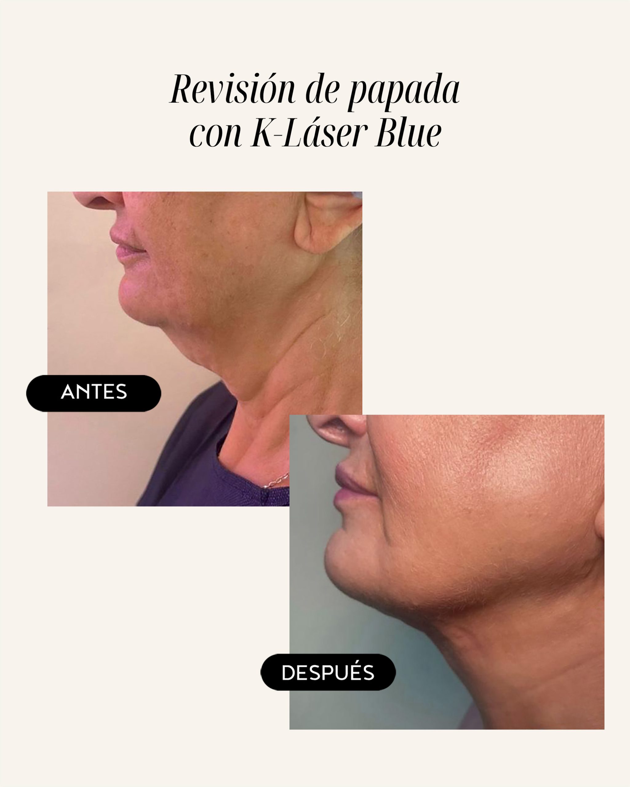 papada-01